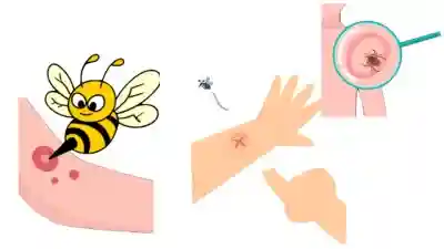 Prevención a las picaduras de insectos, MOSQUITOS Y GARRAPATAS,que causan diferentes enfermedades