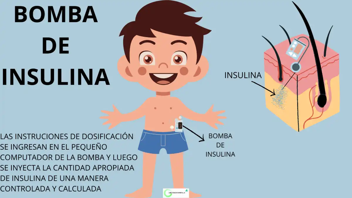 Bomba insulina, diabetes tipo1, tipo2 y gestacional.