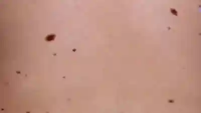 Manchas o hiperpigmentaciones: manchas en la piel, tipos de manchas en la piel,como se forman las manchas en la piel, ¿cuándo hay que preocuparse por una mancha en la piel