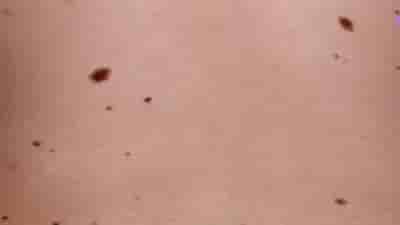 Manchas en la piel o hiperpigmentaciones: manchas en la piel, tipos de manchas en la piel,como se forman las manchas en la piel, ¿cuándo hay que preocuparse por una mancha en la piel