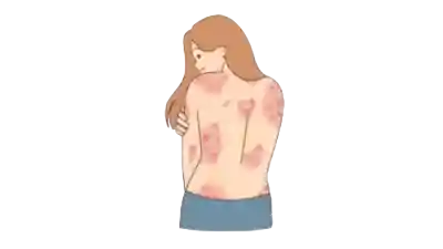 Sarna o escabiosis, qué es, como curar las sarna o escabrosis, tratamiento para las sarna o escabiosis, precauciones a tomar para evitar la sarna o escabiosis