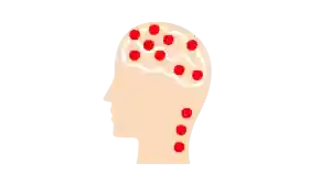 migraña, dolor de cabeza, tipos de dolor de cabeza, cefaleas, migraña crónica, migraña crónica, prevención de la migraña, la migraña como enfermedad incapacitante