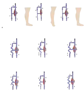 Piernas con varices visibles, síntoma común de insuficiencia venosa crónica. Clasificación CEAP de la insuficiencia venosa crónica con grados y síntomas. Representación anatómica del sistema venoso en las extremidades inferiores. Elevación de piernas como medida preventiva para mejorar el retorno venoso. Medias de compresión para tratar la insuficiencia venosa crónica. Remedios naturales como rusco y castaño de indias usados para aliviar los síntomas de la insuficiencia venosa. Síntomas de insuficiencia venosa crónica durante el embarazo.