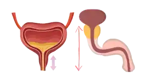 CISTITIS e Infecciones Urinarias: Lo Que Necesitas Saber Para PREVENIR, IDENTIFICAR y TRATAR