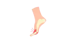 Bienestar de los pies, como cuidar de tus pies, pies sanos cuerpos sano, prevenir molestias de los pies, espolón, ampollas en los pies, neuroma de Morton, fascitis plantar. Trucos para el cuidado de tus pies